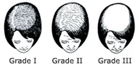 Ludwig Classification diagram showing grades I, II and III of female hair loss