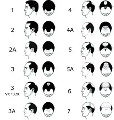 Hamilton-Norwood diagram showing stages of male pattern baldness