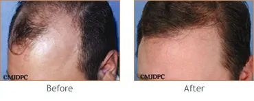 Hair Transplant before and after 1