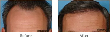 Hair Transplant before and after 2