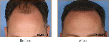 Hair Transplant before and after 3