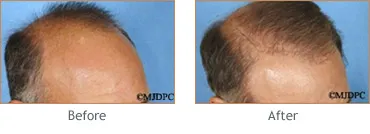 Hair Transplant before and after 5