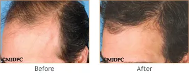 Hair Transplant before and after 7