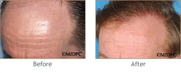 Hair Transplant before and after 8