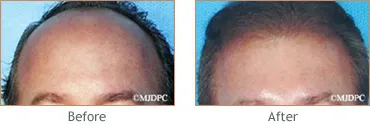 Hair Transplant before and after 9