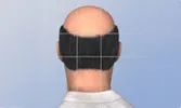 Balding man with donor region indicated