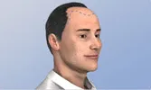 Balding man with hair transplant pattern outlined